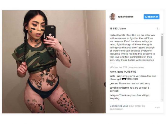 Atteinte-de-vitiligo-cette-jeune-femme-transforme-son-corps-en-oeuvre-d-art