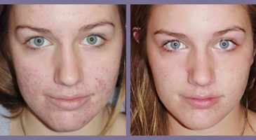 Comment faire un masque contre l’acné ? - %%sitename%%