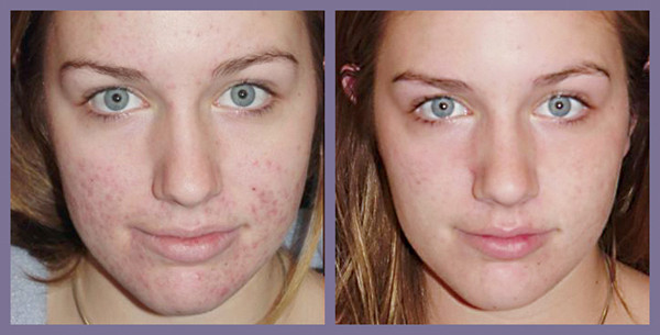 Comment-faire-un-masque-contre-l-acne
