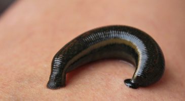 Une sangsue de 6cm retirée du corps d'une petite fille de 6 an - %%sitename%%